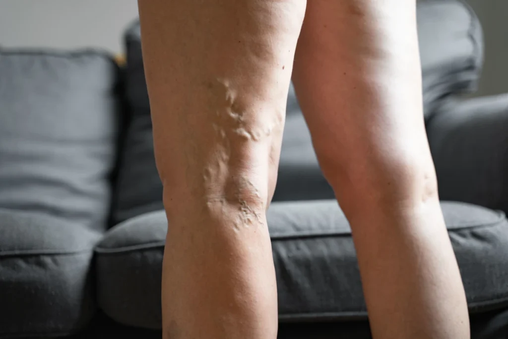 Skleroterapia Katowice