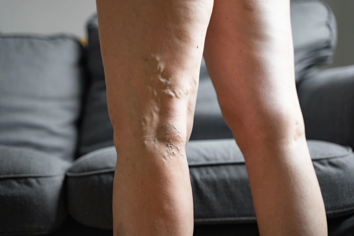 Skleroterapia Katowice